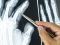 Dłoń na RTG, gdzie palec wskazujący pokazuje zmiany kostne, być może osteofity.
