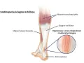 Anatomia łydki z zaznaczonym ścięgnem Achillesa, mięśniami i kością piętową. Widoczna degeneracja ścięgna.