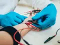 Lekarz w niebieskich rękawiczkach podłącza elektrody do ręki pacjenta. To badanie EMG, które pozwala ocenić funkcje nerwów i mięśni.