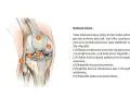 Anatomia kolana, kluczowa dla zrozumienia problemów takich jak gonartroza. Widoczne elementy to rzepka, kłykieć kości udowej, więzadła i łąkotka.
