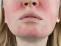 Uczulenie na kwas hialuronowy? Rozwiewam mity i wskazuję winowajców