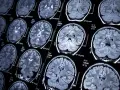 Przekroje mózgu na rezonansie magnetycznym, ukazujące jego strukturę. Badanie może pomóc w diagnozowaniu schorzeń, takich jak epilepsja.