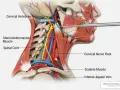 Anatomia szyi z widocznym mięśniem czworobocznym, nerwami i naczyniami. Igła zbliża się do korzenia nerwu szyjnego.
