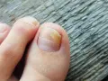 Grzybica paznokci: Kto pomoże? Dermatolog, podolog i skuteczne leczenie