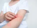 Dziecko drapie ramię pokryte zaczerwienioną, swędzącą wysypką alergiczną.