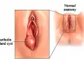 Ilustracja pokazuje cystę gruczołu Bartholina, która jest powiększona w porównaniu do normalnej anatomii.