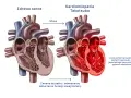 Syndrom złamanego serca: Czy to zawał? Objawy i leczenie