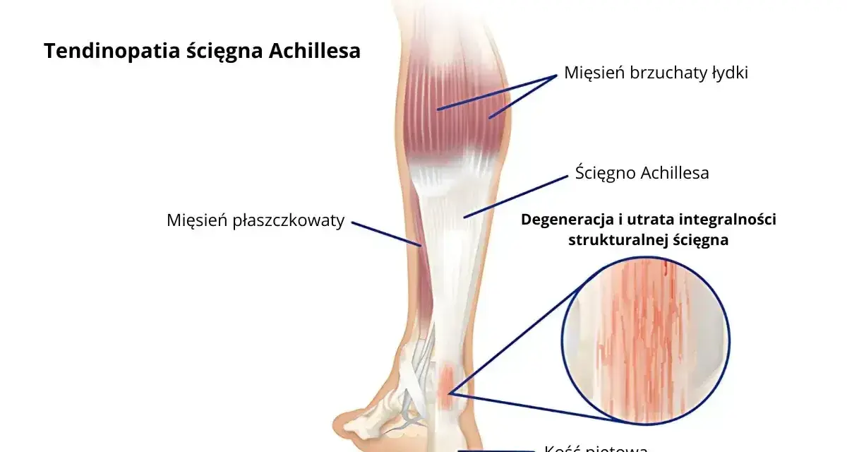 Anatomia łydki z zaznaczonym ścięgnem Achillesa, mięśniami i kością piętową. Widoczna degeneracja ścięgna.