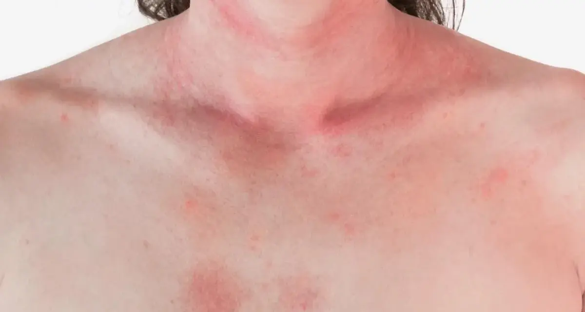 Czy truskawki uczulają? Alergia, nietolerancja objawy i leczenie