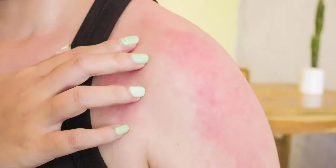Alergia na wodę? Poznaj prawdziwe przyczyny swędzenia po prysznicu.
