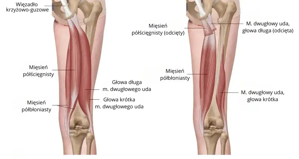 Anatomia mięśni uda: mięsień półścięgnisty i półbłoniasty, głowy mięśnia dwugłowego uda.