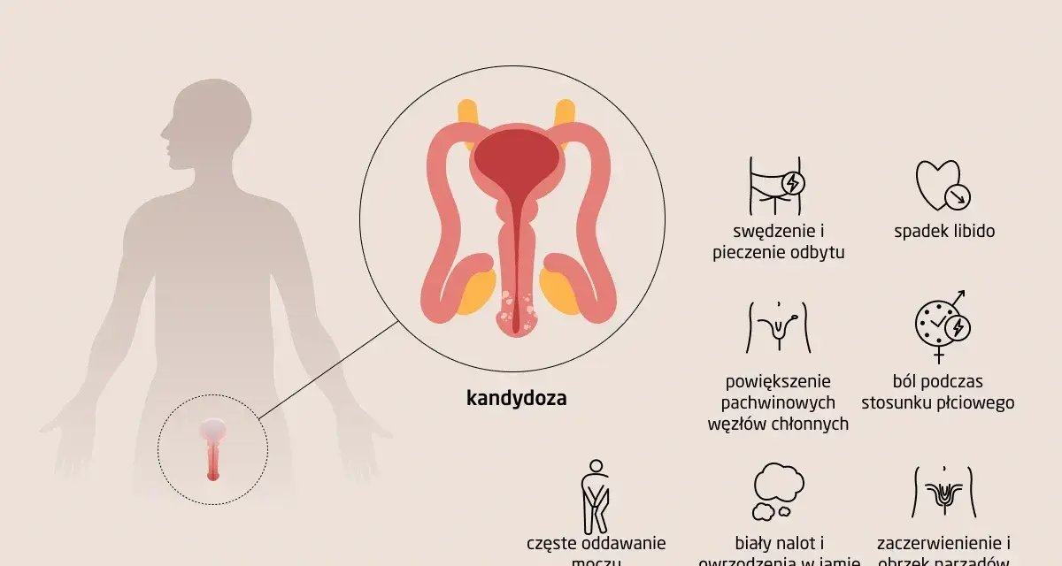 Ilustracja przedstawia objawy grzybicy penisa u mężczyzn, w tym zaczerwienienie, obrzęk narządów płciowych, ból podczas stosunku.
