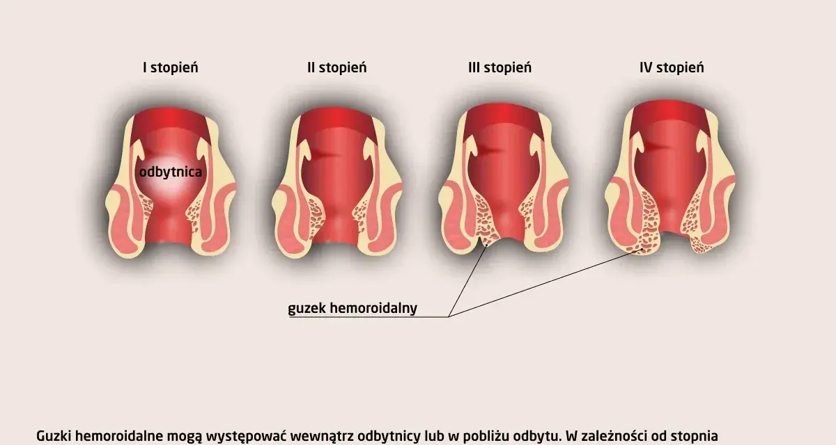 Hemoroidy: Do jakiego lekarza? Proktolog wyjaśnia, co musisz wiedzieć