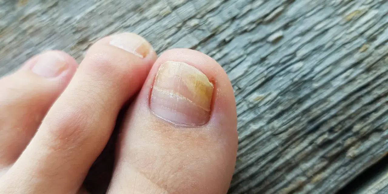 Grzybica paznokci: Kto pomoże? Dermatolog, podolog i skuteczne leczenie