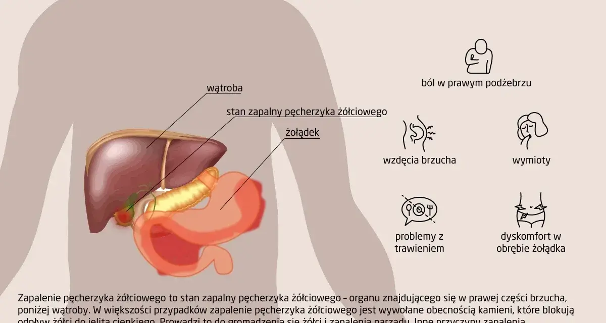Ilustracja przedstawia anatomię jamy brzusznej z zaznaczonym pęcherzykiem żółciowym, wątrobą i żołądkiem. Opisuje objawy zapalenia pęcherzyka żółciowego.