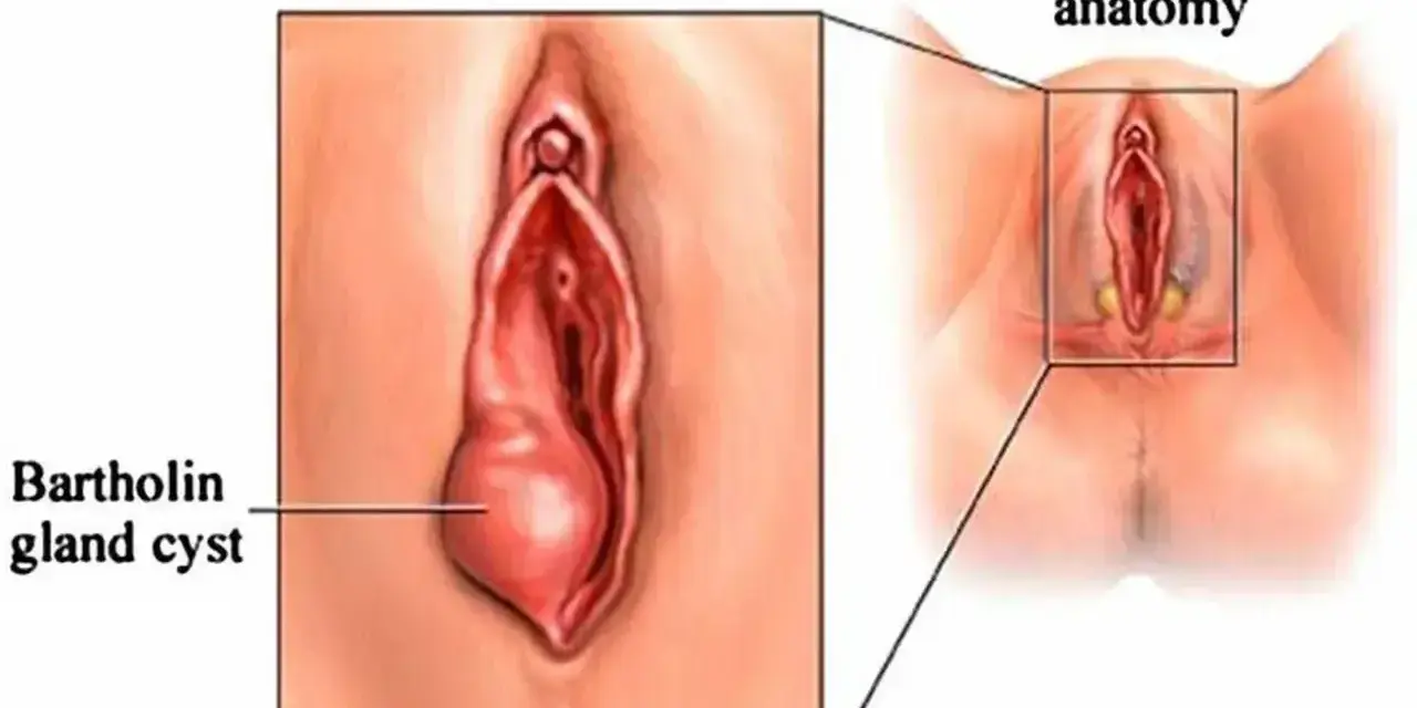 Ilustracja pokazuje cystę gruczołu Bartholina, która jest powiększona w porównaniu do normalnej anatomii.
