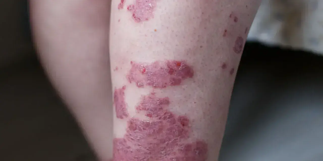 Widoczne czerwone plamy na skórze nogi, niektóre łuszczące się, wskazujące na problem dermatologiczny.