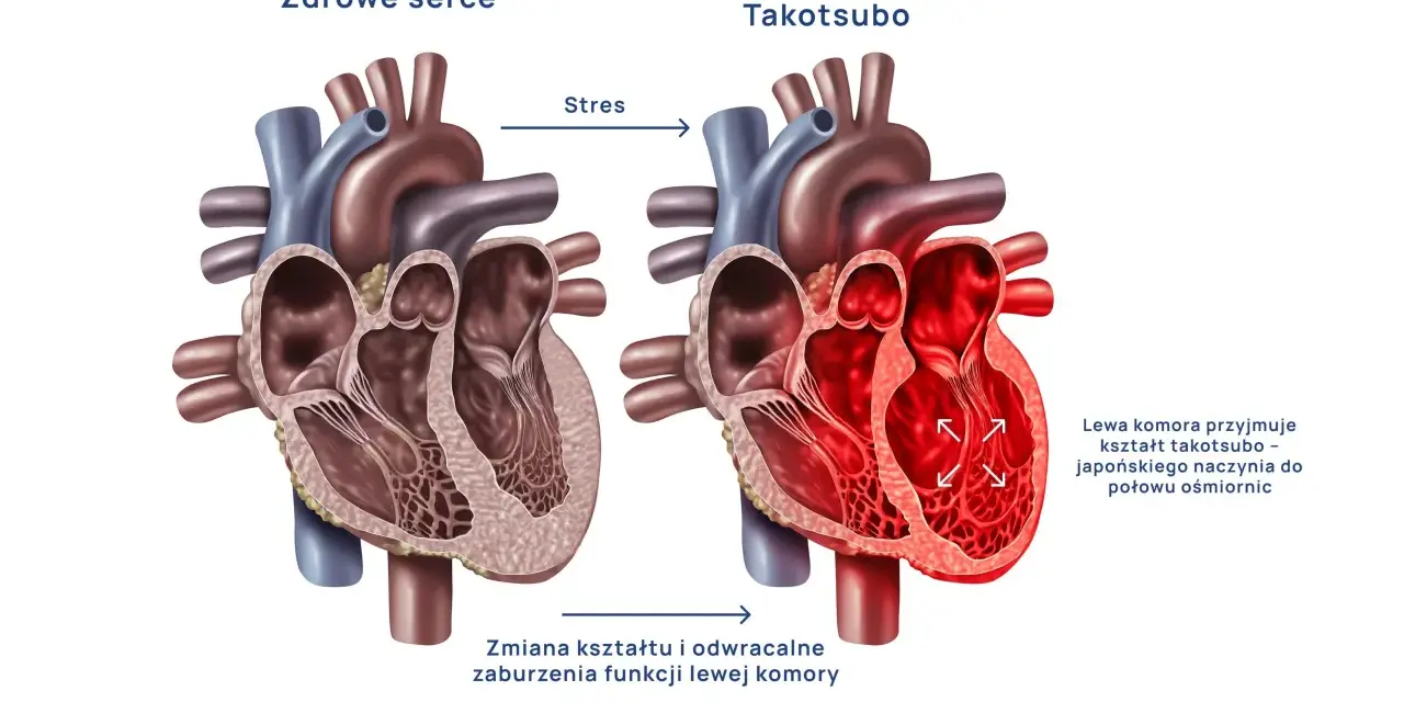 Syndrom złamanego serca: Czy to zawał? Objawy i leczenie