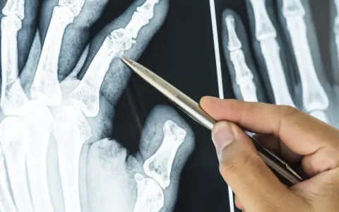 Dłoń na RTG, gdzie palec wskazujący pokazuje zmiany kostne, być może osteofity.