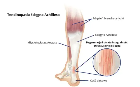 Anatomia łydki z zaznaczonym ścięgnem Achillesa, mięśniami i kością piętową. Widoczna degeneracja ścięgna.