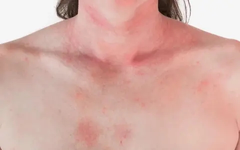 Czy truskawki uczulają? Alergia, nietolerancja objawy i leczenie