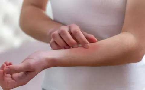 Dłoń drapiąca zaczerwienioną skórę na przedramieniu, objaw mogący wskazywać na lupus.