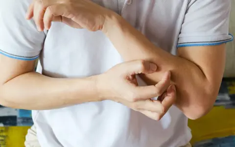 Dłoń drapiąca przedramię, być może jeden z objawów HIV.