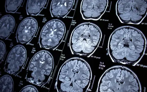 Przekroje mózgu na rezonansie magnetycznym, ukazujące jego strukturę. Badanie może pomóc w diagnozowaniu schorzeń, takich jak epilepsja.