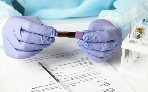 Ręce w rękawiczkach trzymają probówkę z krwią. Wyniki badań wskazują na eozynofile niskie, co może wymagać dalszej diagnostyki.