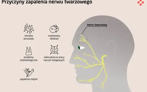 Ilustracja przedstawia przyczyny zapalenia nerwu twarzowego, w tym neuralgia nerwu trójdzielnego, choroby wirusowe, nowotwory, problemy stomatologiczne, zaburzenia naczyń mózgowych i zapalenie mięśni.