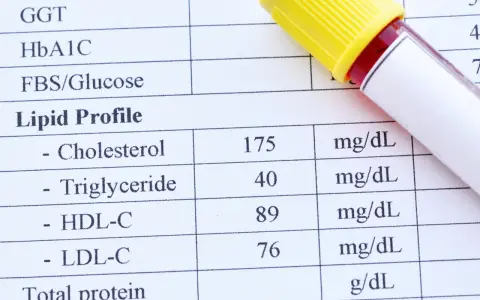 Wynik lipidogramu: cholesterol 175 mg/dL, triglicerydy 40 mg/dL, HDL-C 89 mg/dL, LDL-C 76 mg/dL. Wynik wskazuje na wysoki cholesterol.
