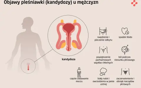 Ilustracja przedstawia objawy grzybicy penisa u mężczyzn, w tym zaczerwienienie, obrzęk narządów płciowych, ból podczas stosunku.