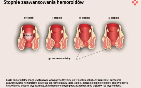 Hemoroidy: Do jakiego lekarza? Proktolog wyjaśnia, co musisz wiedzieć