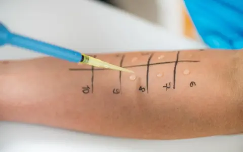 Alergia na miód? Sprawdź, co naprawdę uczula i jak reagować
