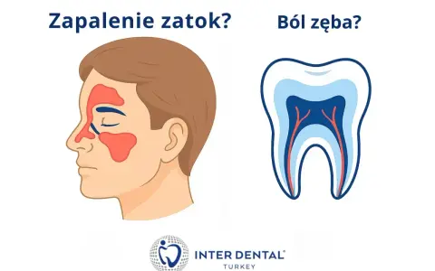 Zapalenie zatok czy ból zęba? Ilustracja pokazuje zatoki i przekrój zęba. Szukasz co na ból zęba?