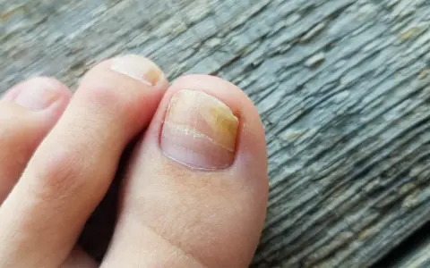 Grzybica paznokci: Kto pomoże? Dermatolog, podolog i skuteczne leczenie