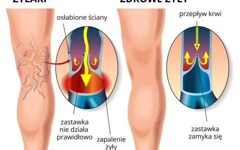 Ilustracja pokazuje nogę z żylakami i zdrową nogę. Flebolog wyjaśnia, że przy żylakach zastawki nie działają, powodując zapalenie.