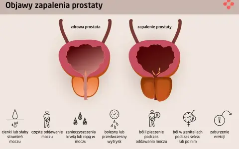 Porównanie zdrowej prostaty i zapalenia prostaty. Objawy zapalenia prostaty: słaby strumień moczu, ból, pieczenie, zaburzenia erekcji.