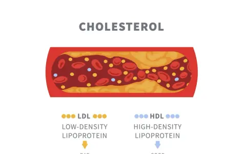 Przekrój naczynia krwionośnego z osadem cholesterolowym. Obok oznaczenia LDL (zły) i HDL (dobry) wskazują na normę cholesterolu całkowitego.