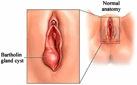 Ilustracja pokazuje cystę gruczołu Bartholina, która jest powiększona w porównaniu do normalnej anatomii.
