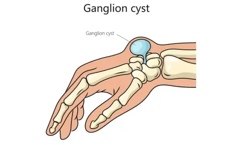 Przekrój dłoni ukazujący kości i ganglion.