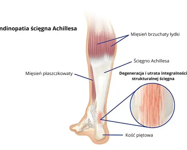 Anatomia łydki z zaznaczonym ścięgnem Achillesa, mięśniami i kością piętową. Widoczna degeneracja ścięgna.
