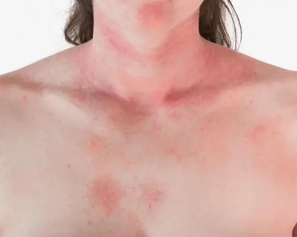 Czy truskawki uczulają? Alergia, nietolerancja objawy i leczenie