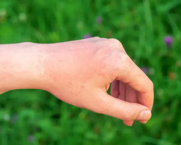 Alergia: Kiedy leki zaczynają działać? Szybka ulga i mity