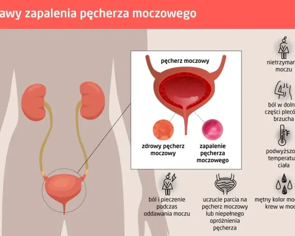 Pieczenie przy sikaniu? Jakie leki na zapalenie cewki moczowej?