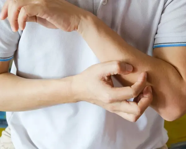 Dłoń drapiąca przedramię, być może jeden z objawów HIV.