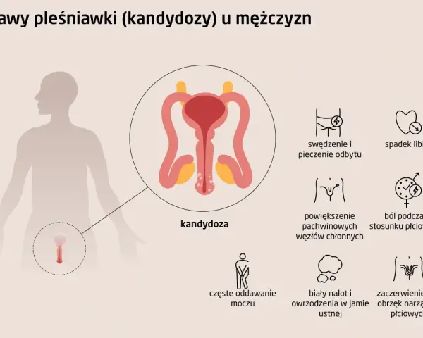 Ilustracja przedstawia objawy grzybicy penisa u mężczyzn, w tym zaczerwienienie, obrzęk narządów płciowych, ból podczas stosunku.