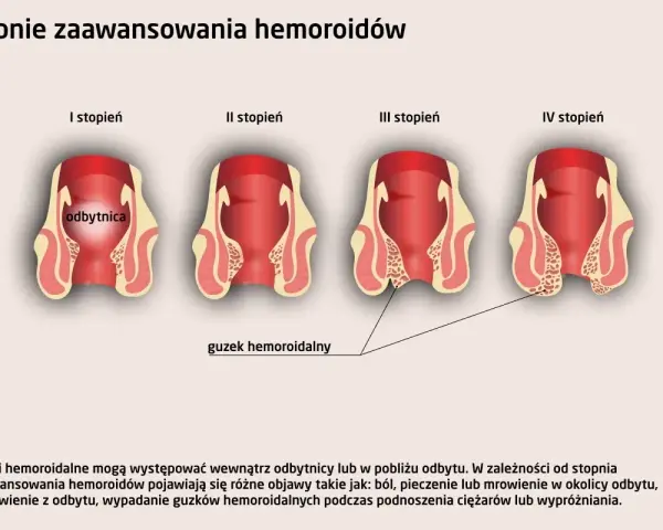 Hemoroidy: Do jakiego lekarza? Proktolog wyjaśnia, co musisz wiedzieć