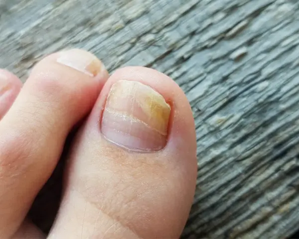Grzybica paznokci: Kto pomoże? Dermatolog, podolog i skuteczne leczenie