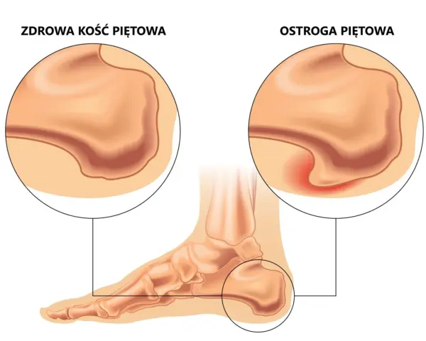 Ostroga piętowa: Jakie leki naprawdę pomogą? Kompleksowy poradnik.